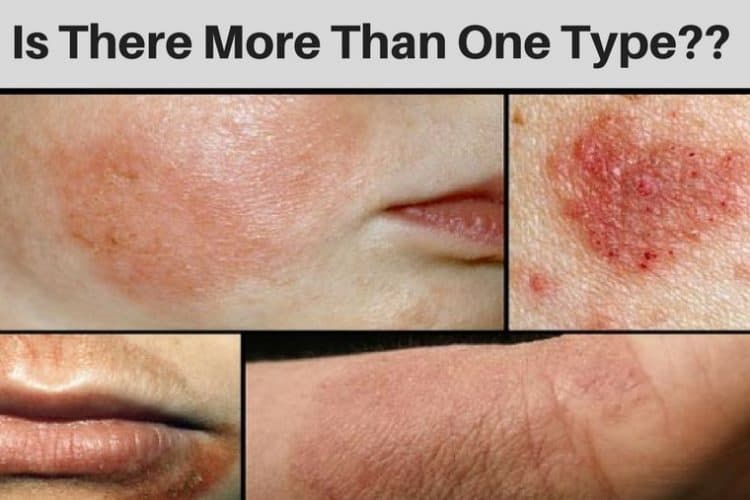 Eczema: Is There More Than One Type? - OurEczema