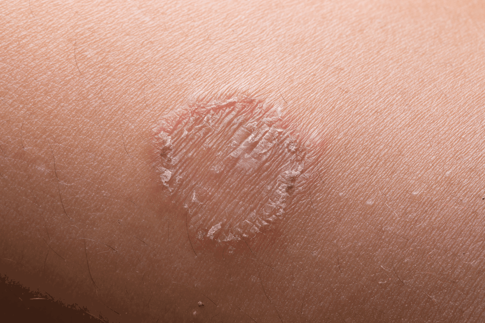 Difference Between Nummular Eczema And Ringworm Our Eczema