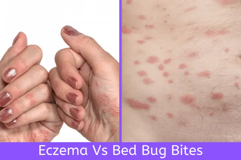 Eczema vs. Bed Bug Bites How to Tell the Difference? (W/Pics)