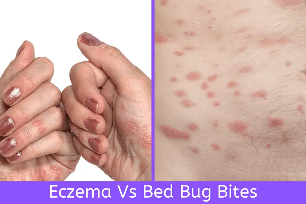 Eczema Vs Bed Bug Bites How To Tell The Difference Wpics